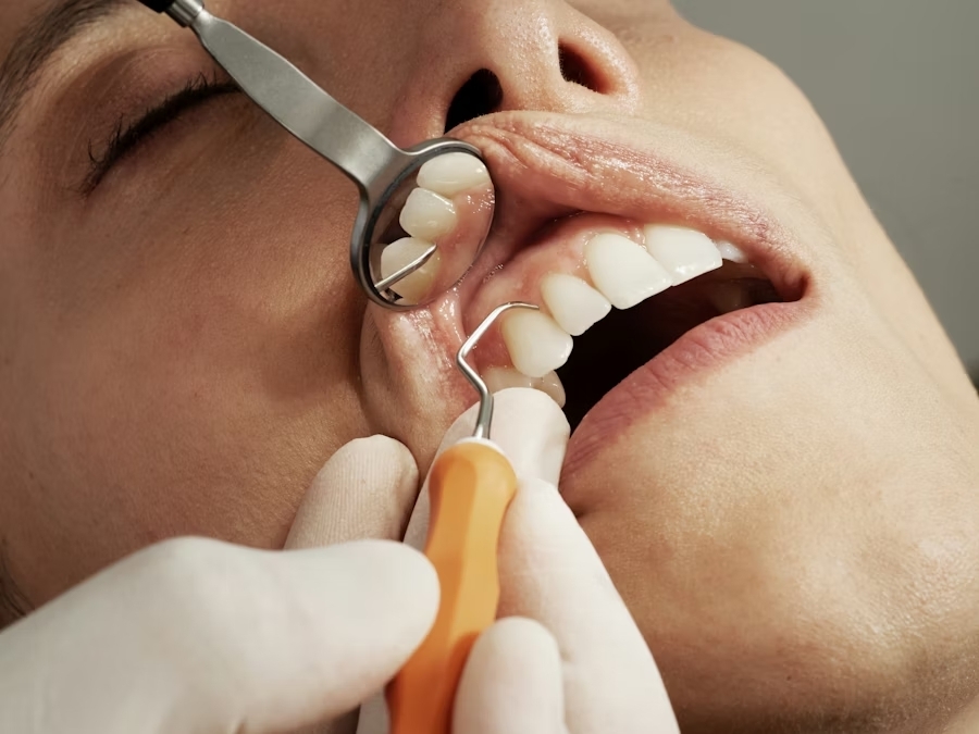 Blanqueamiento dental Viña del Mar