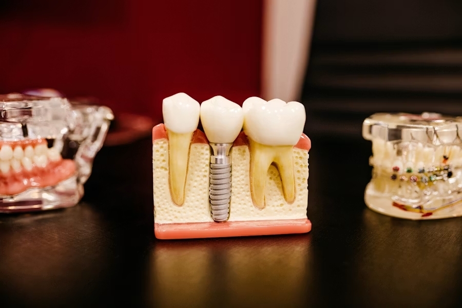 Prótesis dentales Viña del Mar